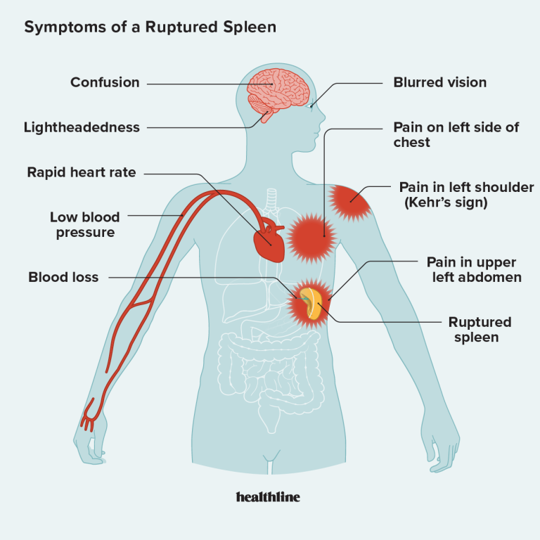 Can Slipping And Falling Cause Spleen Injury?