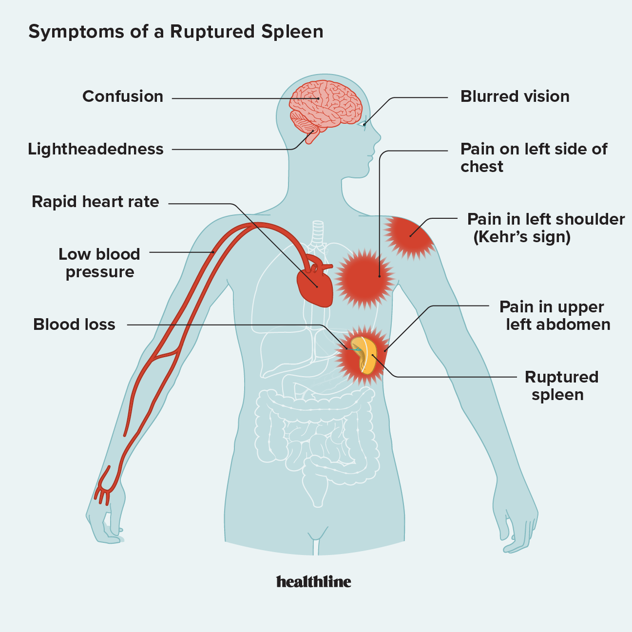 2519944 Ruptured Spleen 1296x1296 body 1