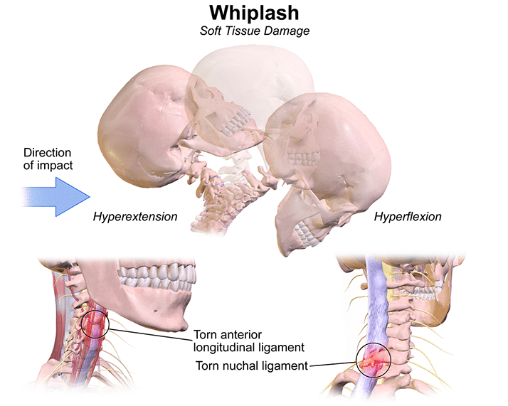 Chiropractic for Whiplash in St Johns FL