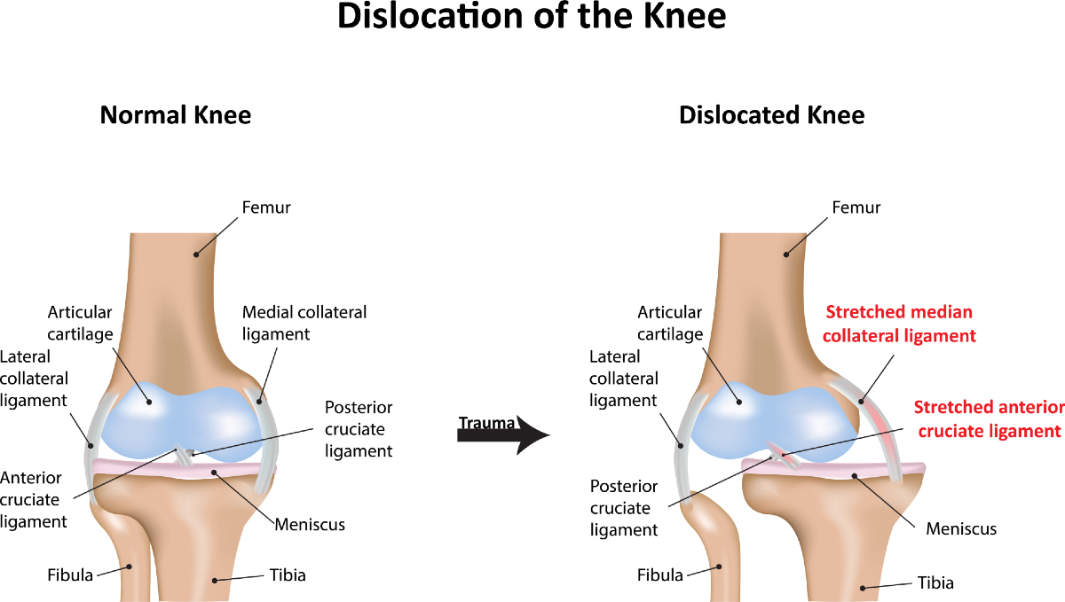 Dislocated Knee