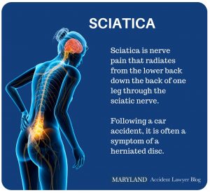 Sciatica1 300x276 1