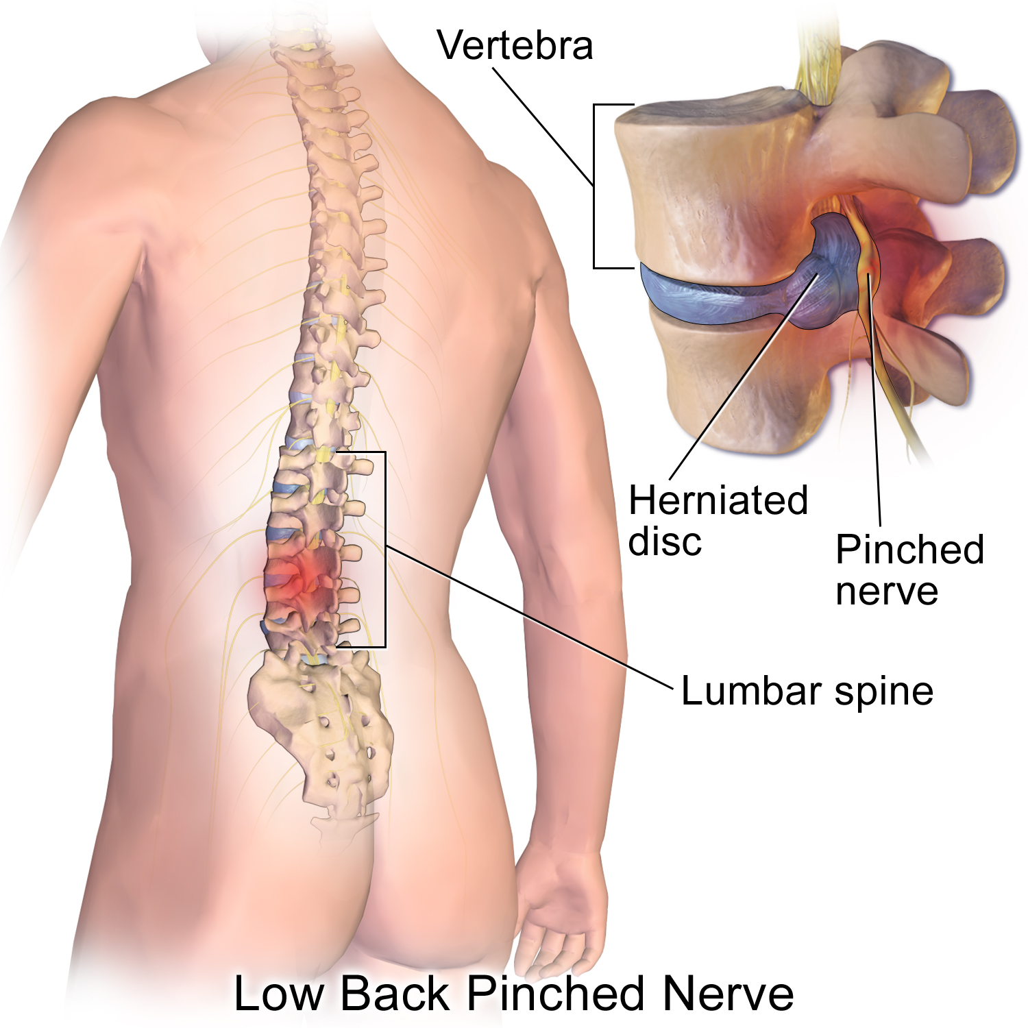 back pain after accident