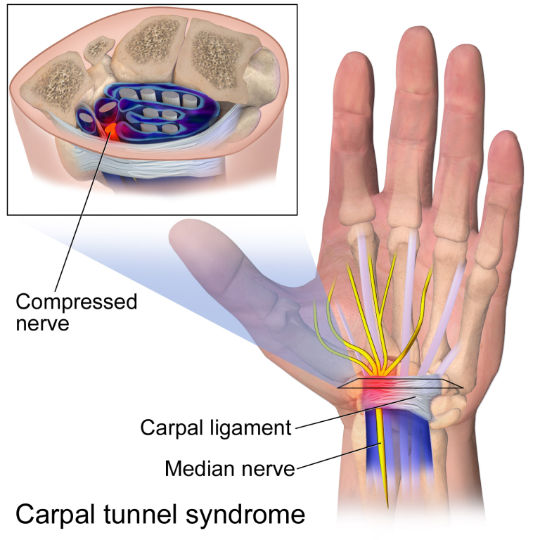 Can Carpal Tunnel Syndrome Be Caused By A Car Accident?