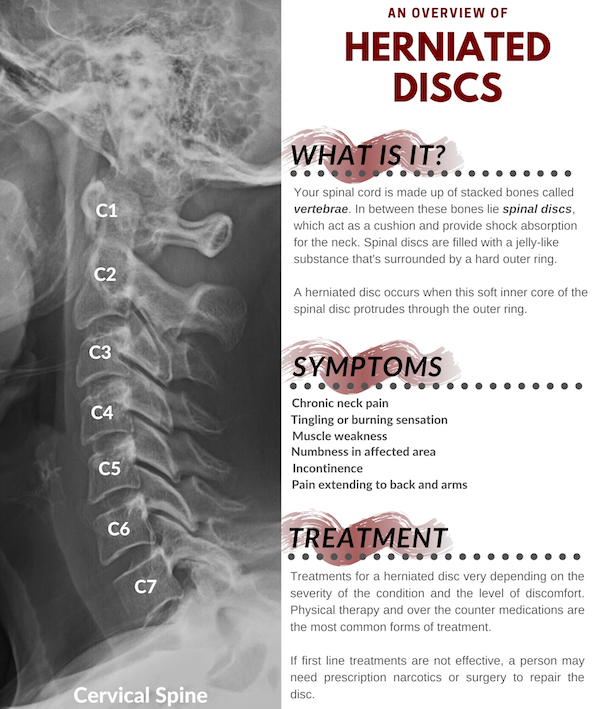 What Are Slipped Discs Worth In Car Accident?