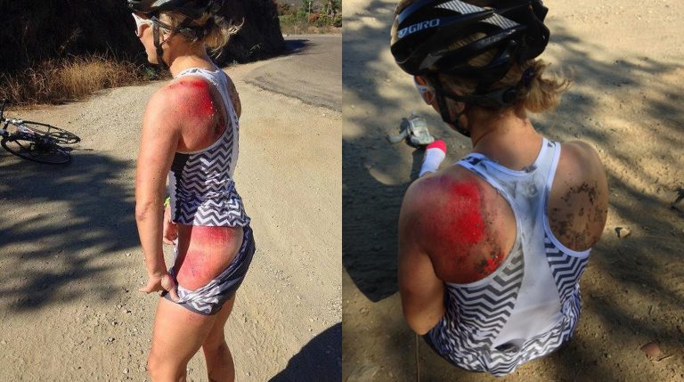 How To Treat Road Rash From Bike Accident?