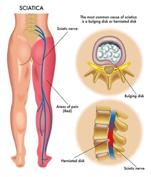 sciatica pain