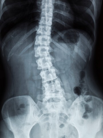 scoliosis after auto accident