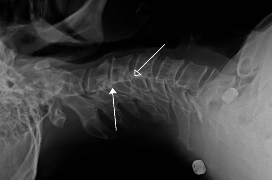 Can A Car Accident Cause Retrolisthesis?